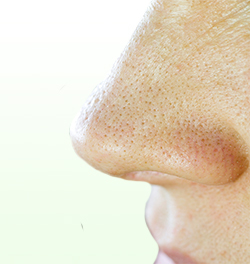 毛穴ピーリングで、たるみ毛穴と呼ばれている涙型毛穴の改善。